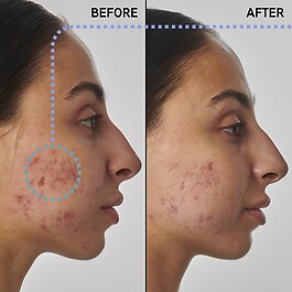 Lösung gegen Narben, Makel und Falten Retinol 1 % - Gesichtsserum